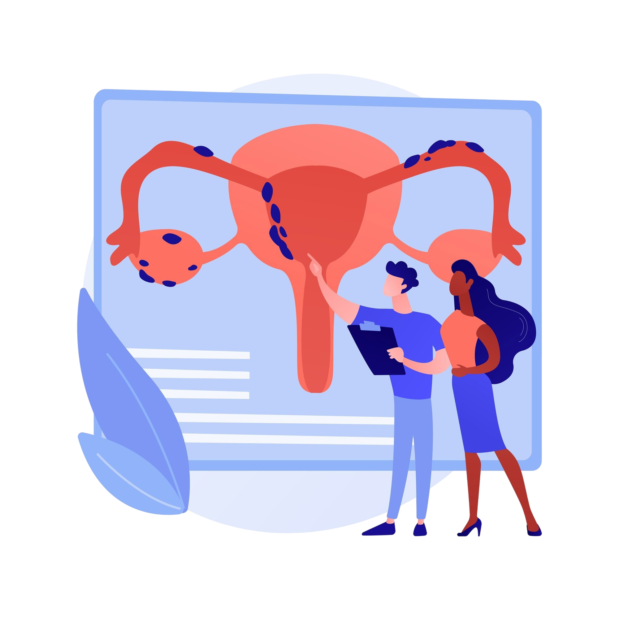 Ilustración médica sobre endometriosis - útero y ovarios con representación de tejido endometrial ectópico